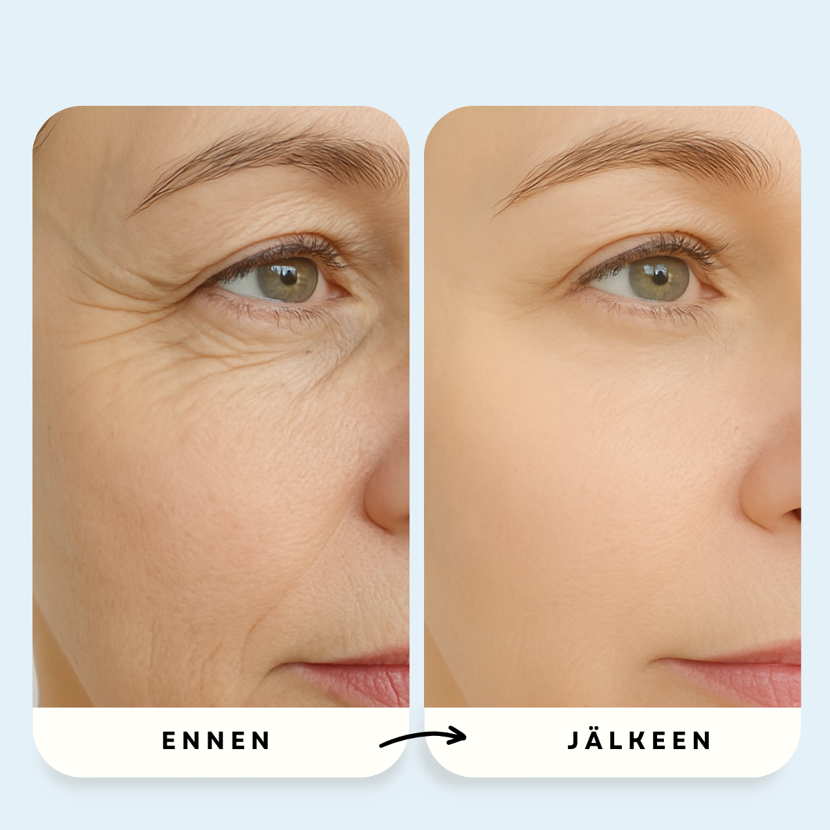 Mikro-Infuusio Anti-Age -Hoito™ – 10 vuotta nuoremman näköinen iho kotona