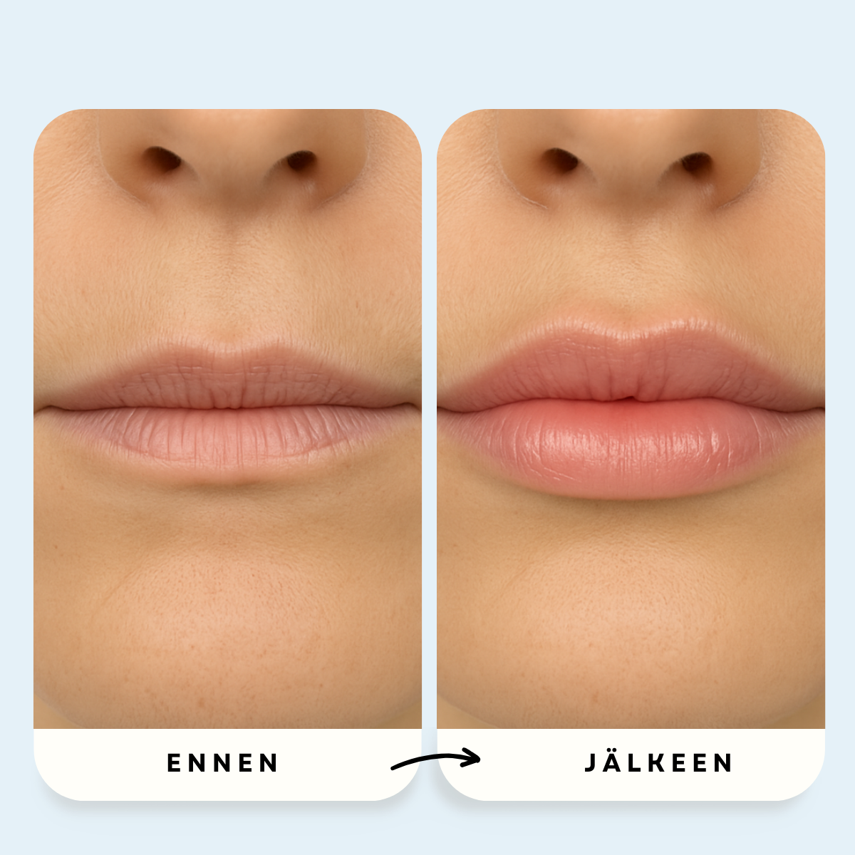 Mikro-Infuusio Anti-Age -Hoito™ – 10 vuotta nuoremman näköinen iho kotona